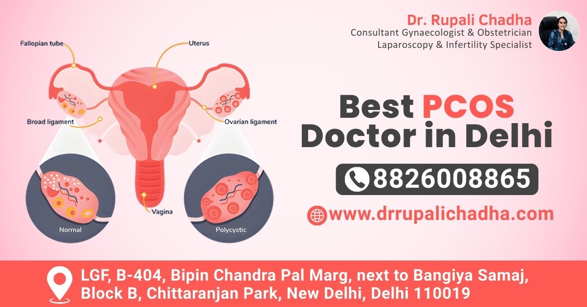 You are currently viewing Best PCOS Doctor in Delhi – Expert Care for Hormonal Balance
