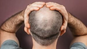 Read more about the article Can Crown Hair Transplant Stop Further Hair Loss?