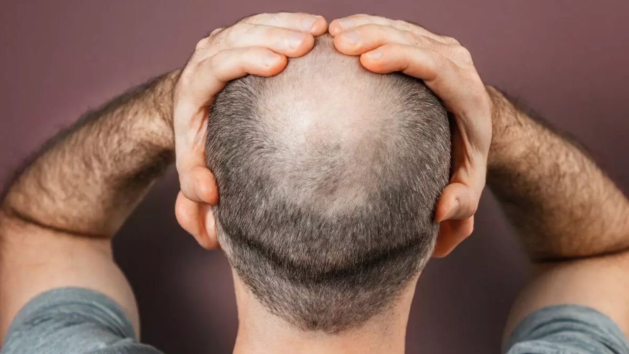 Read more about the article Can Crown Hair Transplant Stop Further Hair Loss?