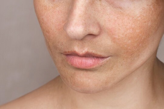 Read more about the article Can Pigmentation Treatment Reduce Age Spots?