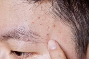 Read more about the article Does Acne Treatment Work on Scars and Dark Spots