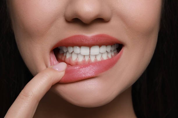 You are currently viewing Does Gum Recession Treatment Improve Smile Aesthetics?