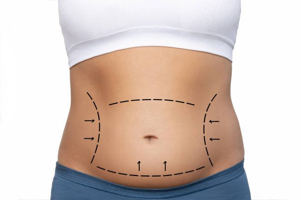 You are currently viewing Does Tummy Tuck Help Fix Separated Abdominal Muscles?