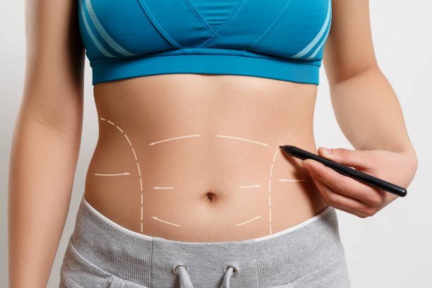 You are currently viewing Does Tummy Tuck Improve Skin Tightness Permanently?
