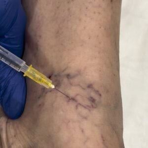 Read more about the article Does Varicose Veins Treatment Work Without Surgery