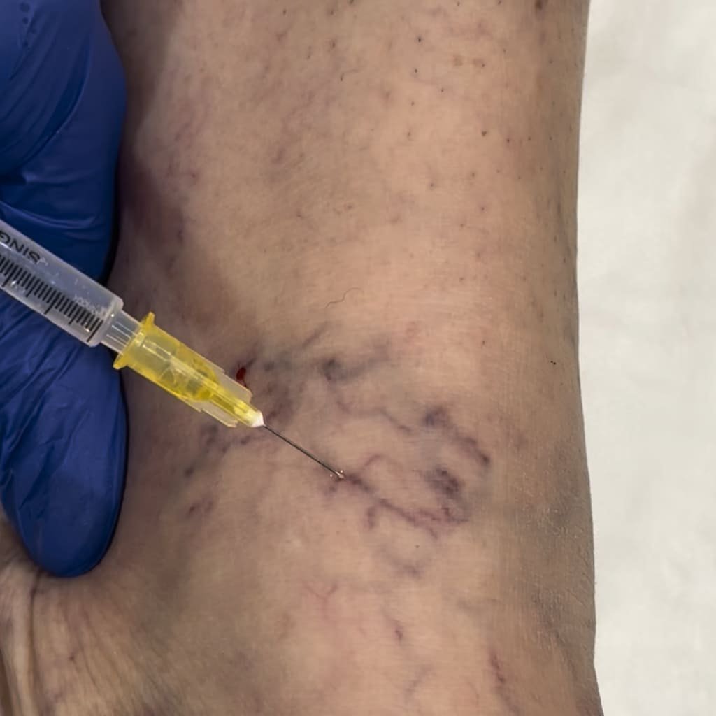 You are currently viewing Does Varicose Veins Treatment Work Without Surgery
