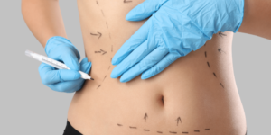 Read more about the article Does a Mini Tummy Tuck Improve Muscle Tone