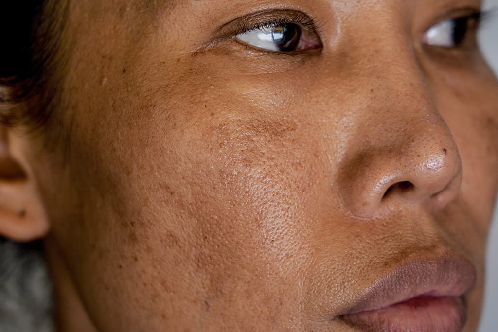 You are currently viewing Dose Pigmentation Treatment Give Lasting Results