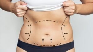 Read more about the article Enhance Your Body Contours with Laser Liposuction