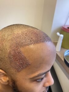 Read more about the article FUE Hair Transplant Using Advanced Technology