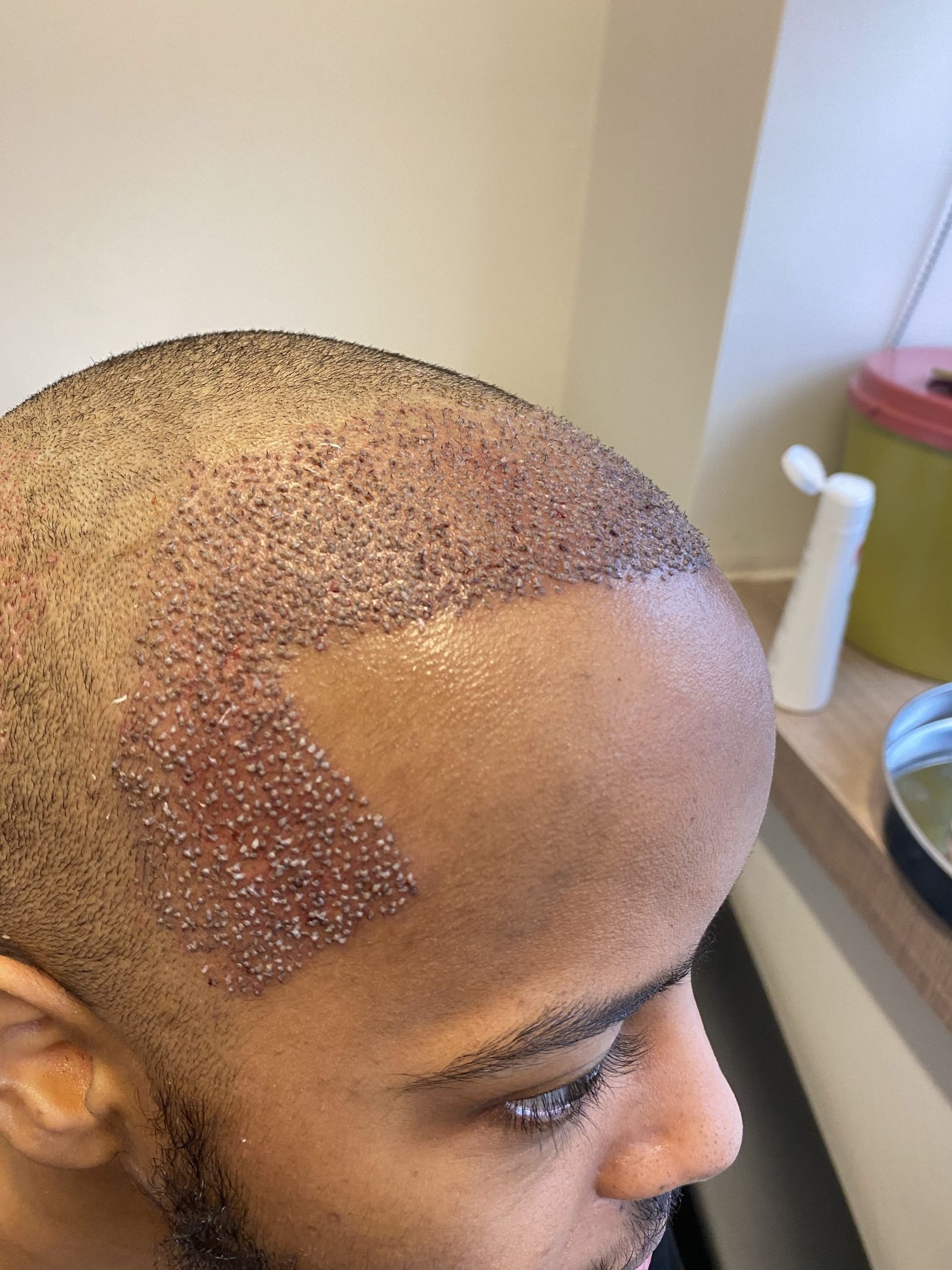 You are currently viewing FUE Hair Transplant Using Advanced Technology