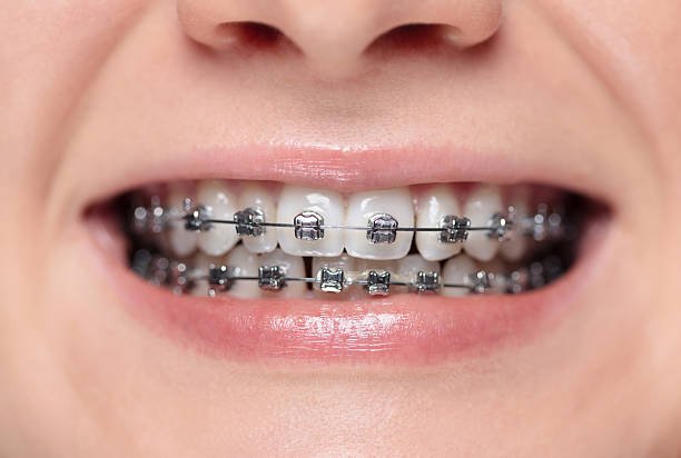 You are currently viewing How Can Dental Braces Improve Smile and Confidence?