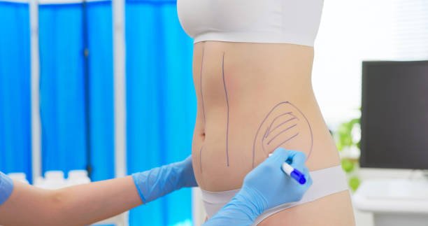 Read more about the article How Does Liposuction Surgery Compare to Tummy Tucks?