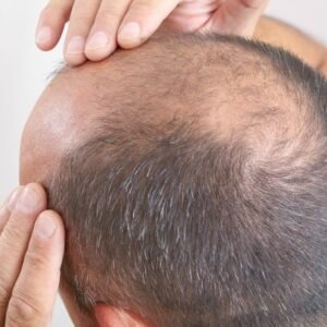 Read more about the article How Effective Is GFC Treatment for Hair Regrowth