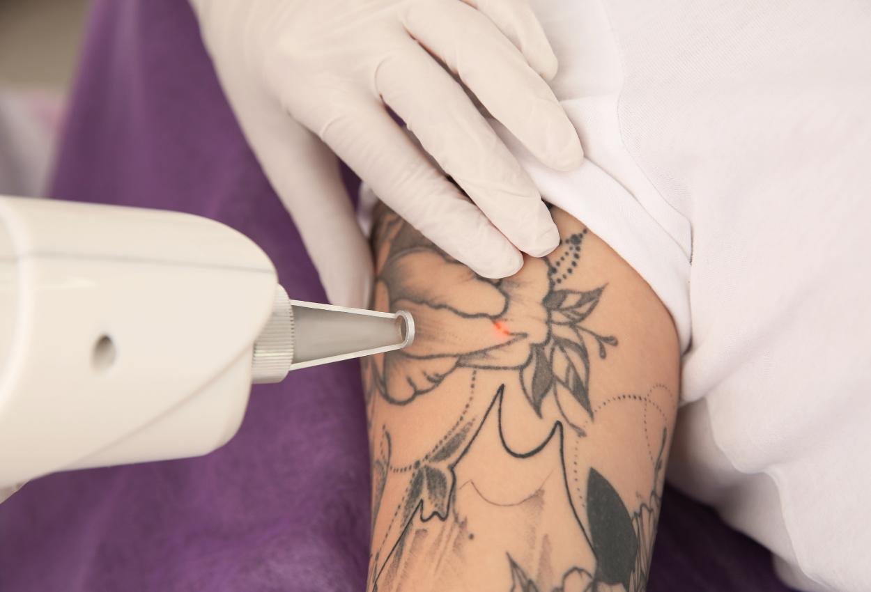 You are currently viewing How Many Sessions Are Needed for Laser Tattoo Removal?