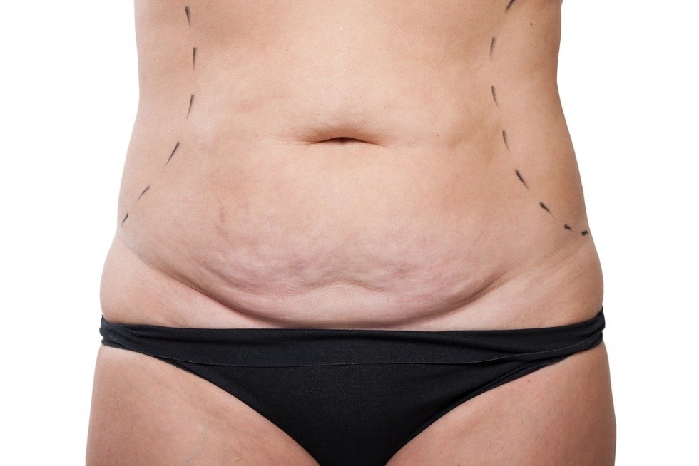 You are currently viewing How Mini Abdominoplasty Improves Body Confidence