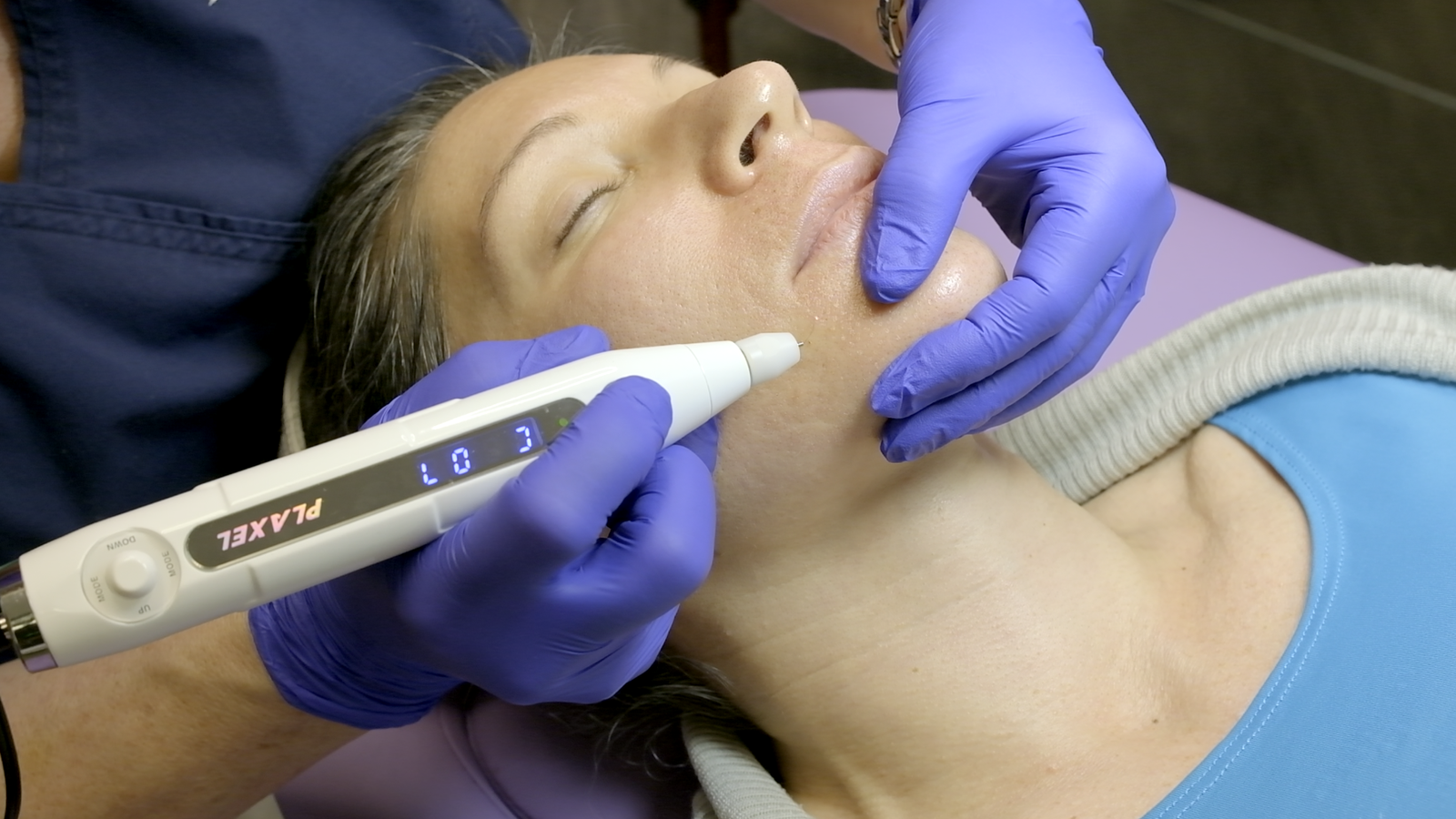 You are currently viewing How Plasma Pen Treatment Works for Skin Lifting