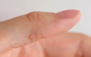Read more about the article How Warts Removal Targets Different Wart Types