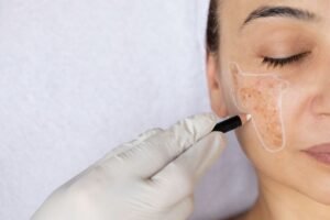 Read more about the article Is Melasma Treatment a Long Term Solution