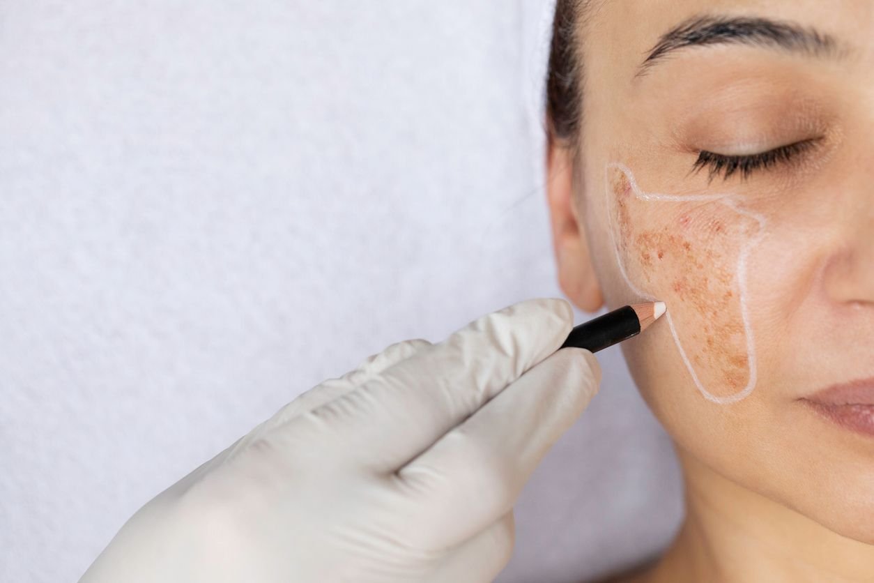 Read more about the article Is Melasma Treatment a Long Term Solution