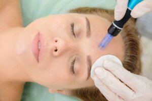 Read more about the article Is Microneedling for Acne Scars Better Than Laser Treatments