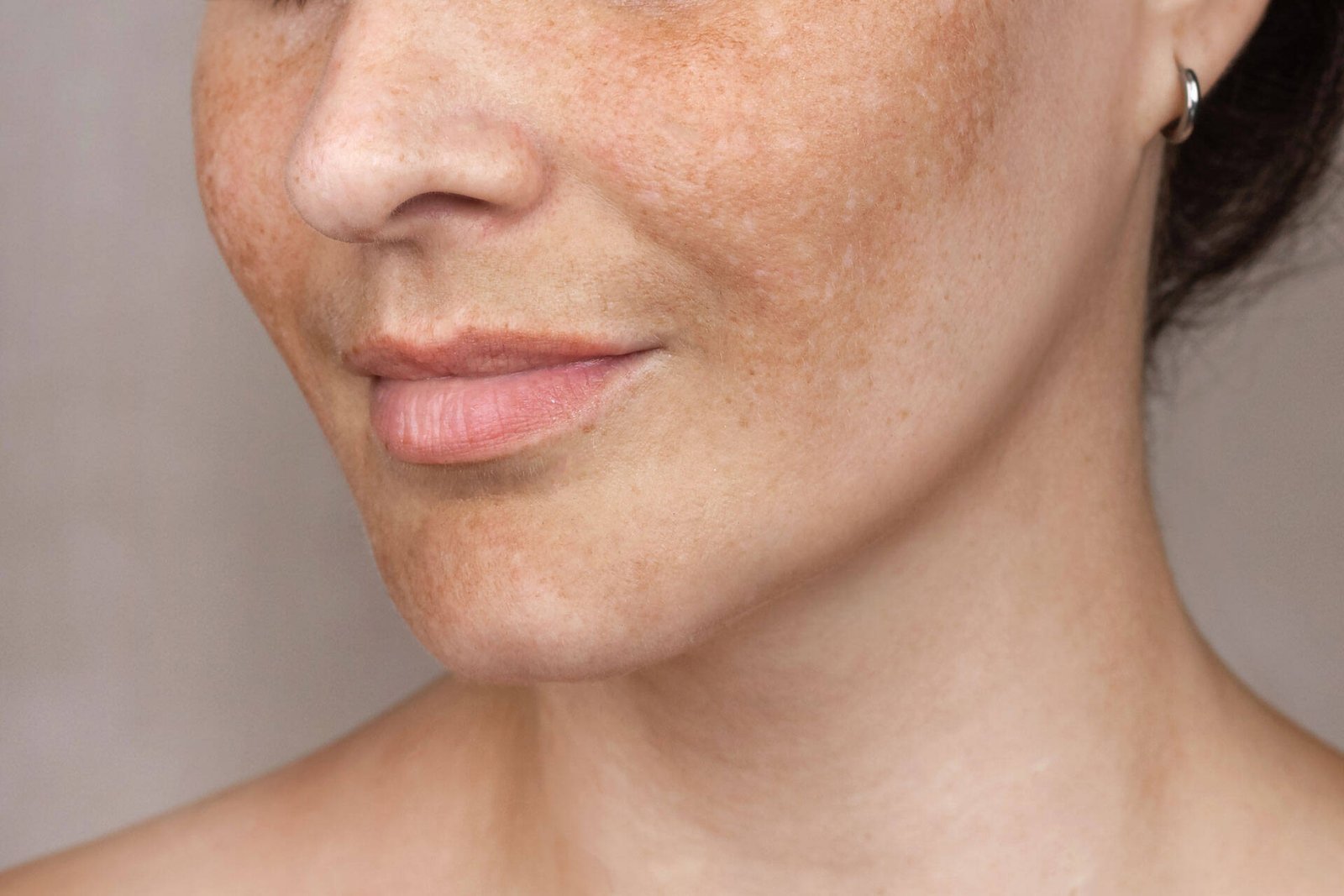 You are currently viewing Is Pigmentation Treatment the Right Choice