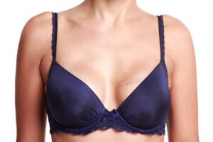 Read more about the article Is Post Surgical Scars Treatment Effective on Body Scars?