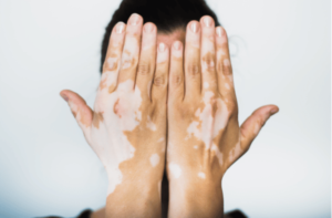 Read more about the article Is Vitiligo Treatment Right for You