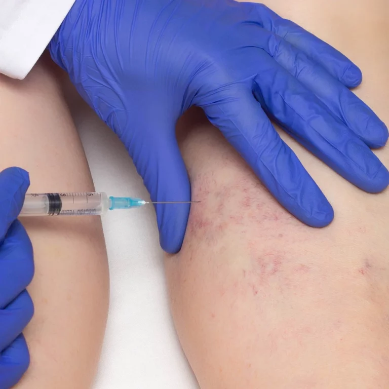 You are currently viewing Premium Spider Veins Treatment Services