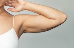 Read more about the article Professional Arm Lift Treatments