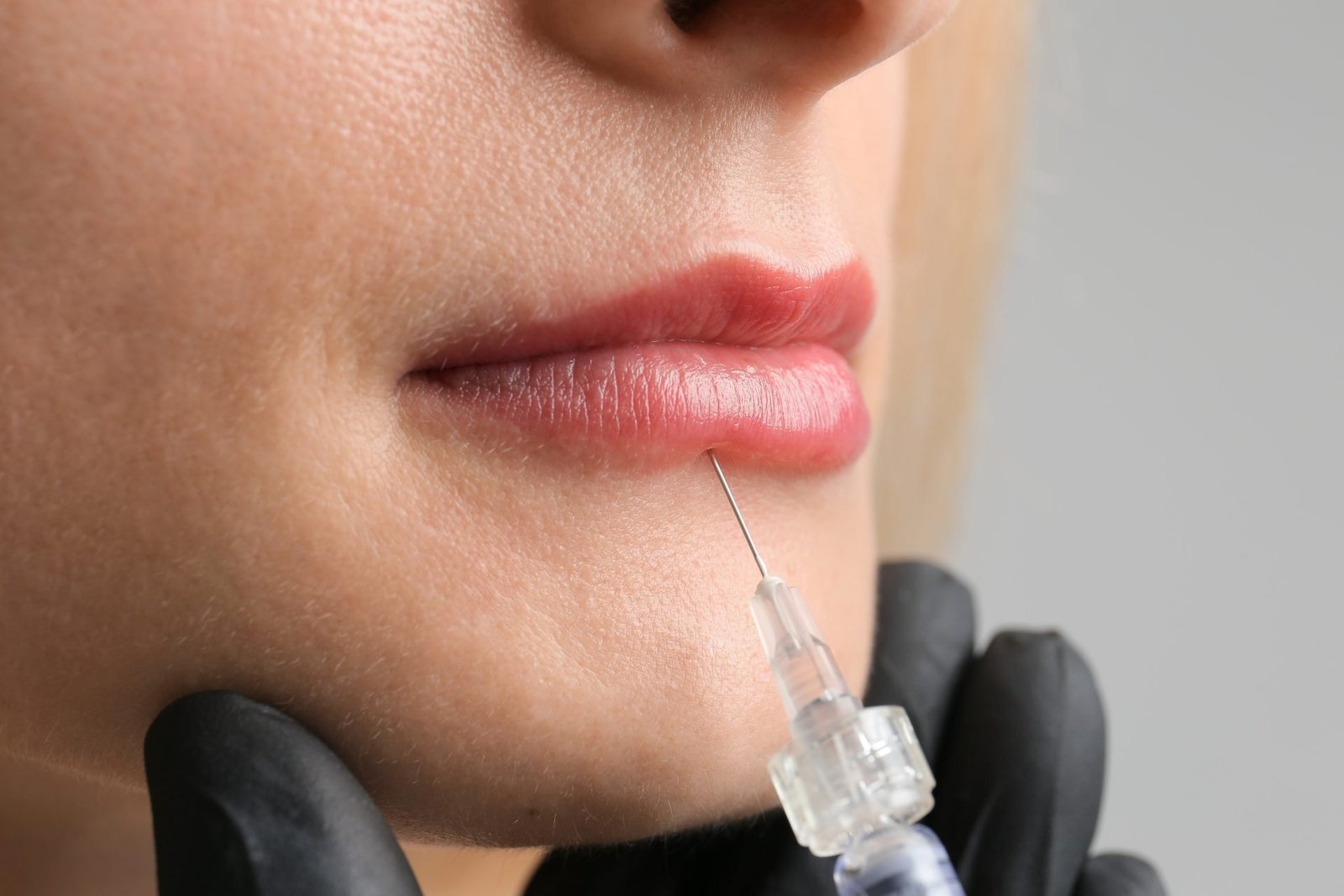 Read more about the article Revitalize Your Smile with Perfectha Fillers