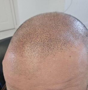 Read more about the article Scalp Micropigmentation Transform Your Appearance Naturally