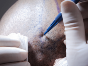 Read more about the article What Aftercare Is Required Following an FUE Hair Transplant?