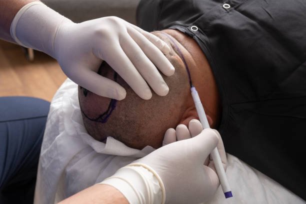 You are currently viewing What Is the Best Technique for Crown Hair Transplant