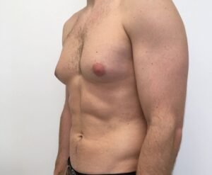 Read more about the article What Results Can Gynecomastia Surgery Deliver