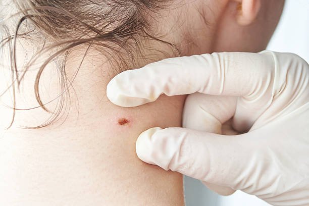 You are currently viewing What to Expect During Warts Removal Procedure?