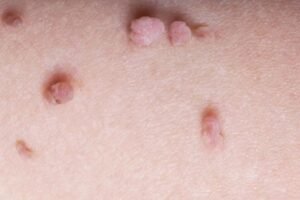 Read more about the article Where to Find Skin Tag Removal Experts
