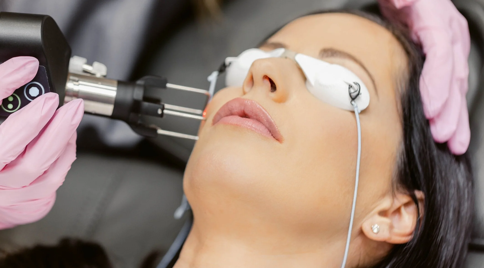 You are currently viewing Fractional CO2 Laser Treatment Cost for Melasma: Is It Recommended?