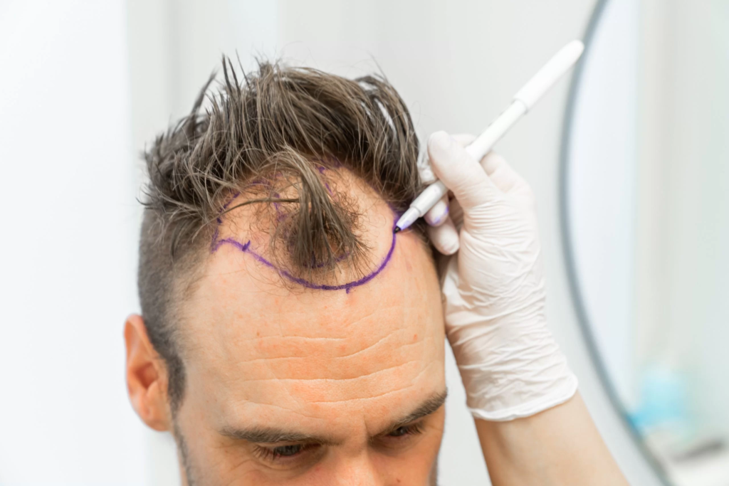 Hair Transplant