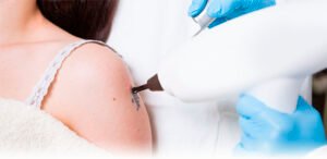Read more about the article Want Smooth, Radiant Skin Instantly With Laser Tattoo Removal Magic?