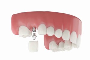 Read more about the article Are Dental Implants Good for Missing Molars?