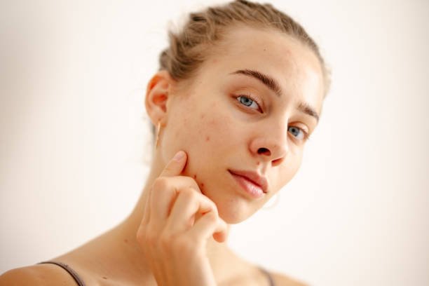 You are currently viewing Can Laser Acne Scar treatment reduce pitted acne scars?
