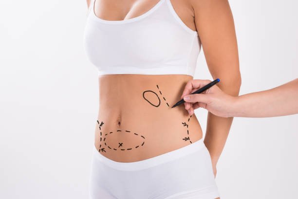 Read more about the article Can Liposuction Abu Dhabi Treat Fat Areas?