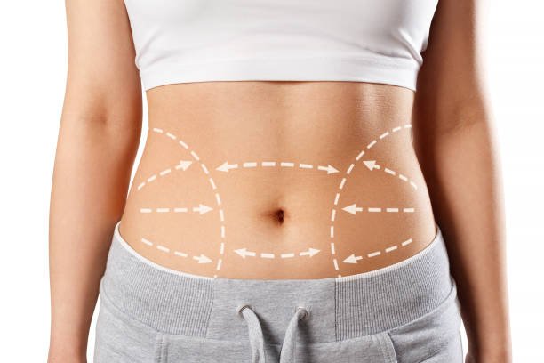 You are currently viewing Can Liposuction Improve Body Shape?