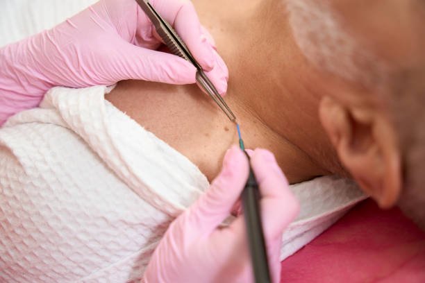 You are currently viewing Can Mole Removal Treat Irritated Moles?