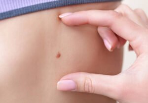 Read more about the article Can Skin Tag Removal Prevent Regrowth?