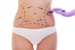 Read more about the article Can Tummy Tuck Fix Muscle Separation?