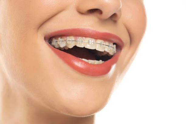 You are currently viewing Do Dental Braces Help Jaw Alignment?