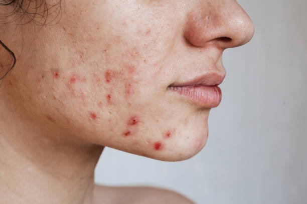 You are currently viewing Does Acne Treatment Help with Hormonal Acne Issues?