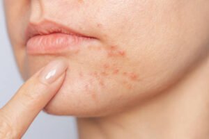 Read more about the article Does Acne Treatment Work for Women?